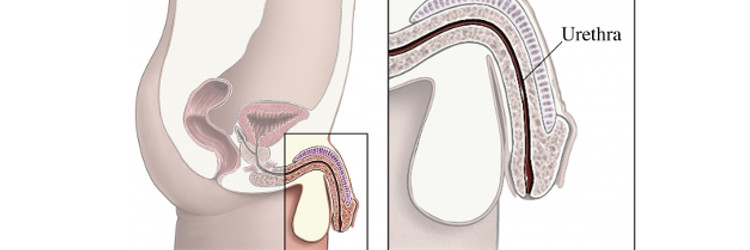 kidney stone disease 1